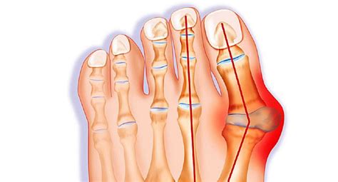 Pictures: Bunion Causes and Treatments