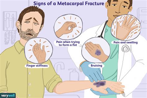 Fractured (Broken) Metacarpal: Symptoms, Causes, Treatment