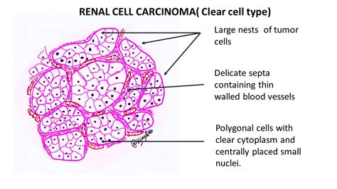 RENAL CELL CARCINOMA- CLEAR CELL TYPE - Pathology Made Simple