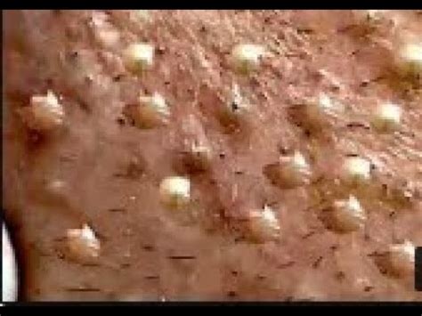 Satisfying Blackheads Removal Acne Treatment Big Blackheads Guide for You #95 - YouTube