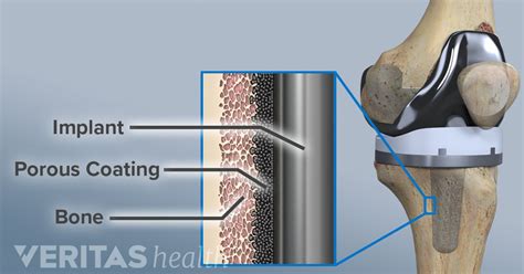 The Pros and Cons of Double Knee Replacement