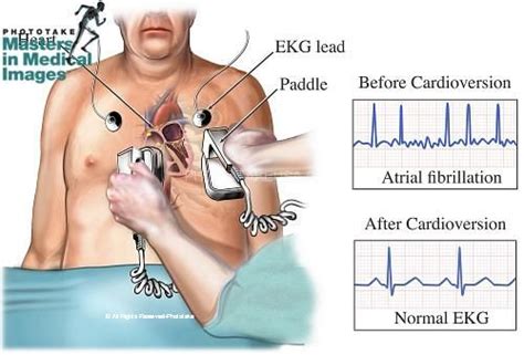 Illustration of cardioversion (electric shock) to revert an abnormal ...