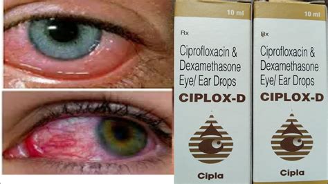 Cetraxal Plus Ear Drops - PF Drops - Carmellose Sodium (preservative free eye drops ... / When ...