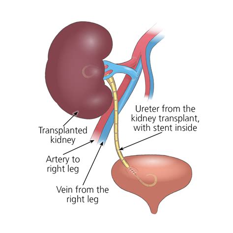 Kidney Transplant Surgery