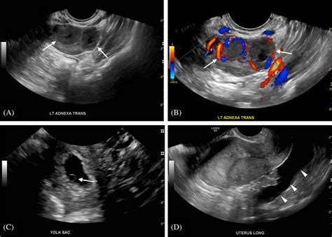 Corpus Luteum Ultrasound