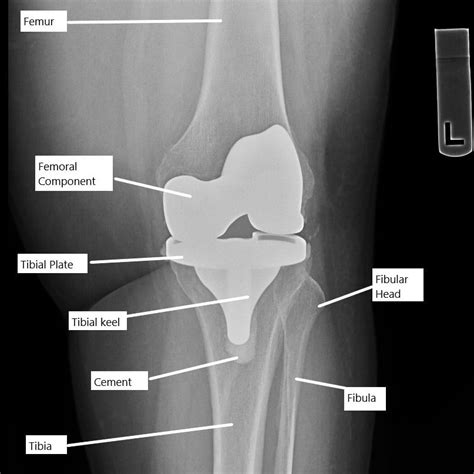 Stiffness after Knee Replacement Surgery - Complete Orthopedics