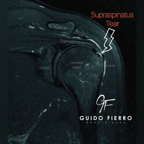 Supraspinatus tear shoulder mri – Artofit