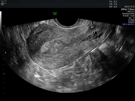 Detecting Endometrial Carcinoma with Ultrasound | Empowered Women's Health