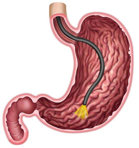 Know More About Gastroscopy and Colonoscopy - Dr Mark Boccola