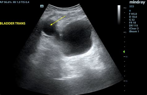 Cureus | Urinary Retention in a Patient With an Artificial Urinary Sphincter: A Case Report of a ...