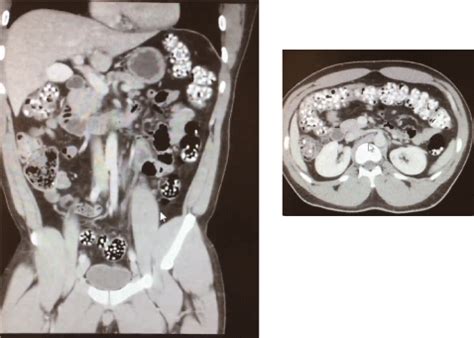 Colonic Phytobezoar Caused by Popcorn Kernels Resulting in a High Grade Large Bowel Obstruction