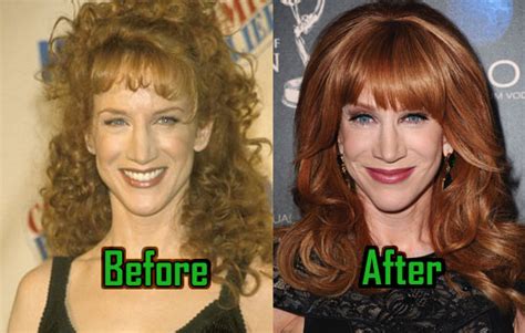 Kathy Griffin Plastic Surgery: Facelift, Liposuction, Before-After! | CelebritySurgeryIcon