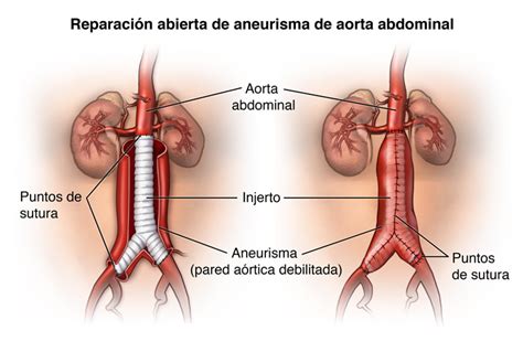 Abdominal Aortic Aneurysm