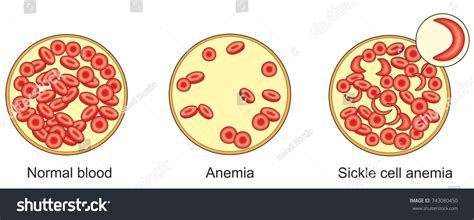 125 Causes Anaemia Images, Stock Photos & Vectors | Shutterstock