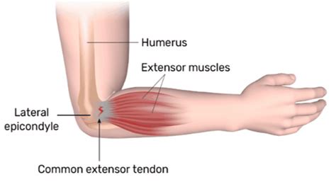 Causes and Treatment of Elbow Pain - Visit Medical Care 1 in Ypsilanti