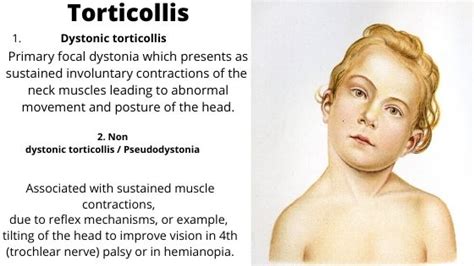 Spontaneous torticollis. Spasmodic Torticollis: Causes, Symptoms, and Effective Treatments for ...