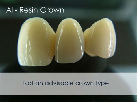 All About Mahkota Gigi – Material Dental Crown | | Global Estetik