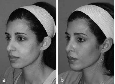 Cheek/Malar Augmentation | Plastic Surgery Key