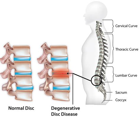 Degenerative Disc Disease | Sportnova UK