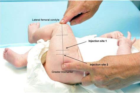 Figure 2.2: Diagram showing suggested sites for multiple injections in the lateral thigh ...