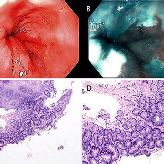 Endoscopic and histological images of a short segment Barrett’s ...