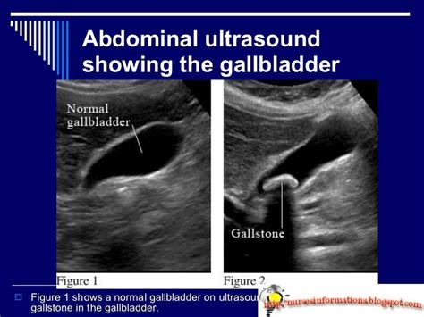 Abdominal Ultrasound | Ultrasound, Abdominal, Nursing information