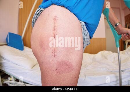 Scar after hip replacement surgery Stock Photo: 67047812 - Alamy