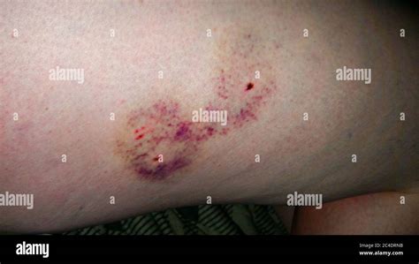 Dog Bite Wound Stock Photo - Alamy