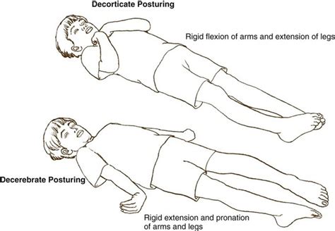 Decorticate Posturing Treatment | Bruin Blog