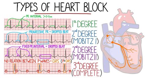 Heart Blocks Made Easy - 1st, 2nd (Mobitz 1/Wenckebach & Mobitz 2), 3rd (Complete) | with ECGs ...