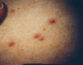 Adult-Type Langerhans Cell Histiocytosis: Minimal Treatment for Maximal Results | MDedge Dermatology