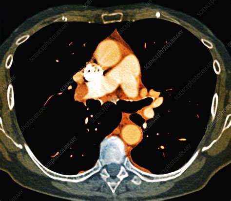 Pulmonary embolism, CT scan - Stock Image - C026/9986 - Science Photo Library