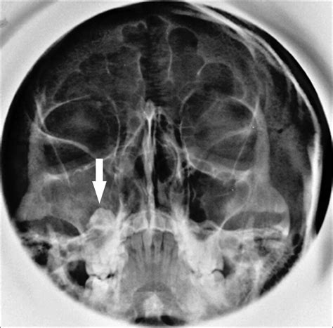 Dentigerous Cyst Maxillary Sinus