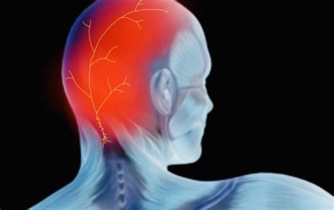 What Triggers Occipital Neuralgia? Common Triggers and How to Prevent Them