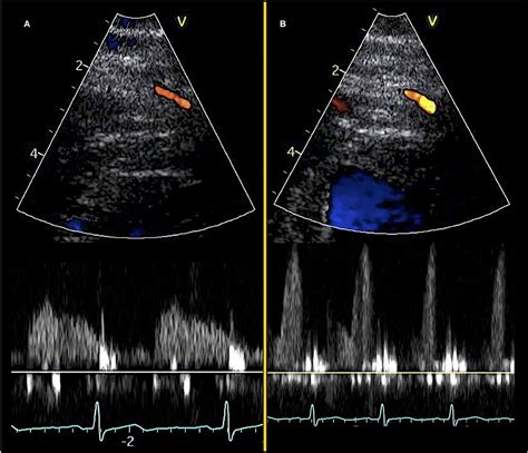 Frontiers | Doppler Echocardiography Assessment of Coronary ...