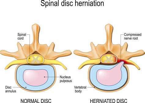 Lumbar Disc Herniation/Sciatica - Upswing Health | Upswing Health