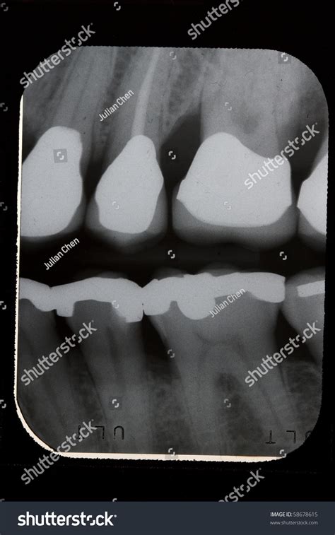 18 Bitewing Radiograph Images, Stock Photos & Vectors | Shutterstock