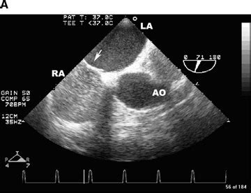 Transesophageal echocardiogram. Bubble study. (A) Even though the right... | Download Scientific ...