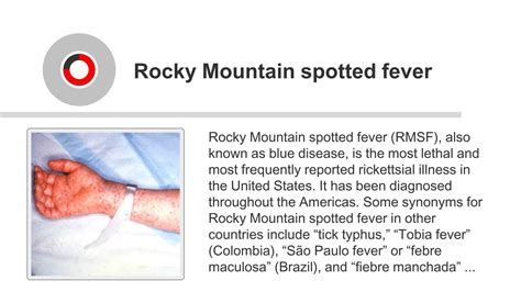 Rocky Mountain Spotted Fever (RMSF) - Bacterial Infections ...