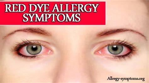 Red Dye Allergy Symptoms, Causes and Treatment - Allergy Symptoms