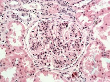 Membranoproliferative Glomerulonephritis: Practice Essentials ...