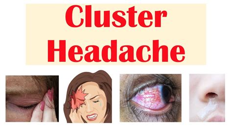 Cluster Headaches | Risk Factors, Triggers, Signs & Symptoms, Diagnosis, Treatment - YouTube