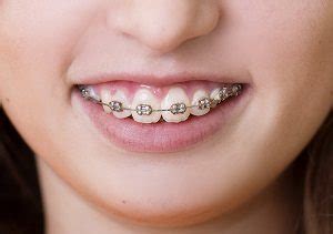 Braces Colors Ideas | Pediatric Dentist San Diego | ABC Dentistry