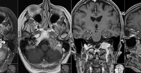 Radiology MRI: Paraganglioma - Glomus Jugulare