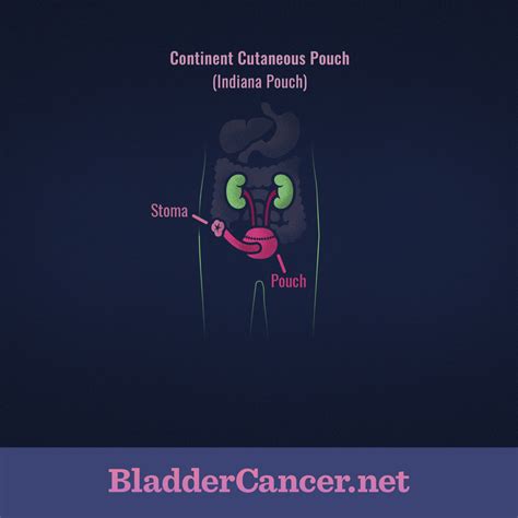 What is an Indiana Pouch? | BladderCancer.net