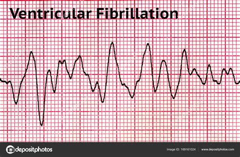 Ventricular Fibrillation