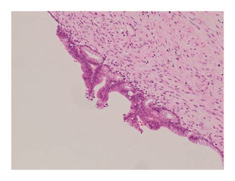 Intraepithelial lesions. (a) H-E stain. Endocervical lesions.... | Download Scientific Diagram