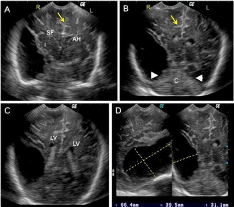 Neonatal brain sonography. a , b Coronal views of the brain confirm the ...