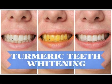 Turmeric Teeth Whitening Does Turmeric Whiten Teeth Hoax How to Use Results Before and After