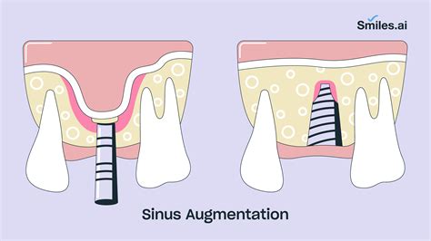 The Dental Implant Procedure – Explained Step by Step